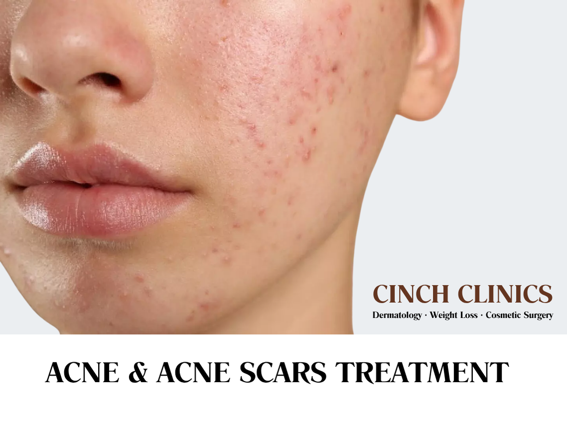 Acne & acne scars at Cinch Clinics